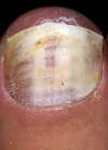 white-superficial-onychomycosis3